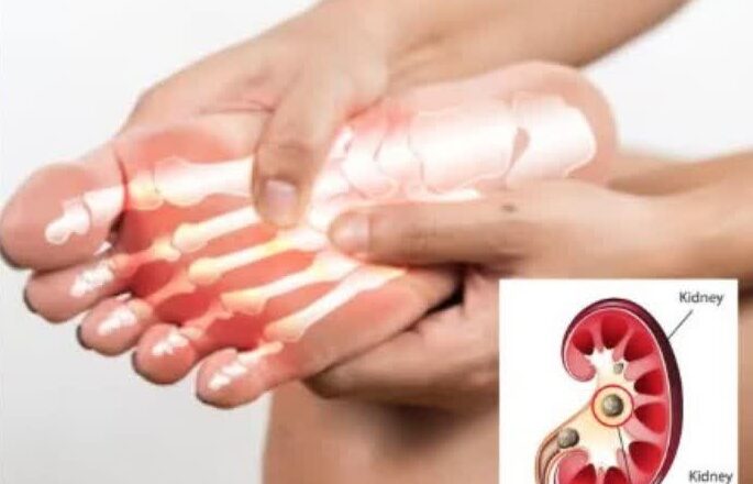 ਆਖਿਰ ਖੁਰਾਕ ਵਿੱਚ ਬਦਲਾਅ ਕਰਨ ਤੋਂ ਬਾਅਦ ਵੀ ਯੂਰਿਕ ਐਸਿਡ ਘੱਟ ਕਿਉਂ ਨਹੀਂ ਹੋ ਰਿਹਾ? ਜਾਣ ਲਓ ਵਜ੍ਹਾਂ